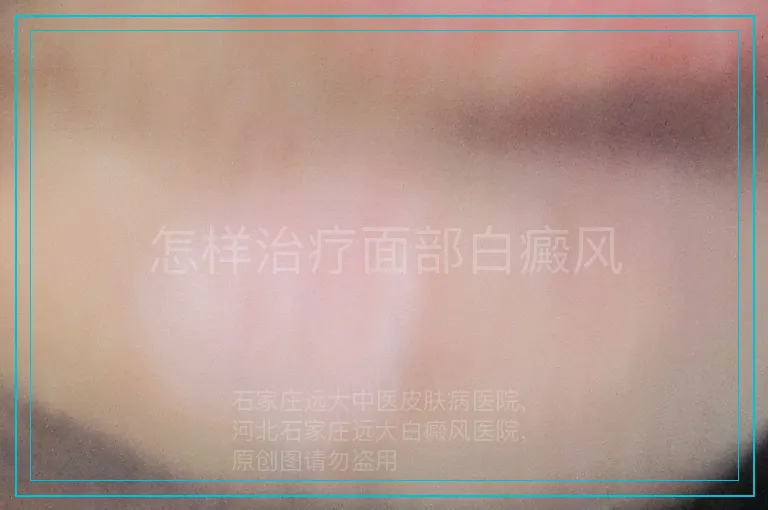 怎样治疗面部白癜风