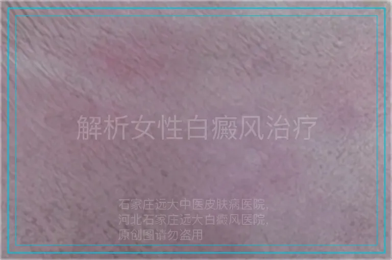 解析女性白癜风治疗