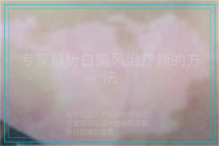 专家解析白癜风治疗新的方法