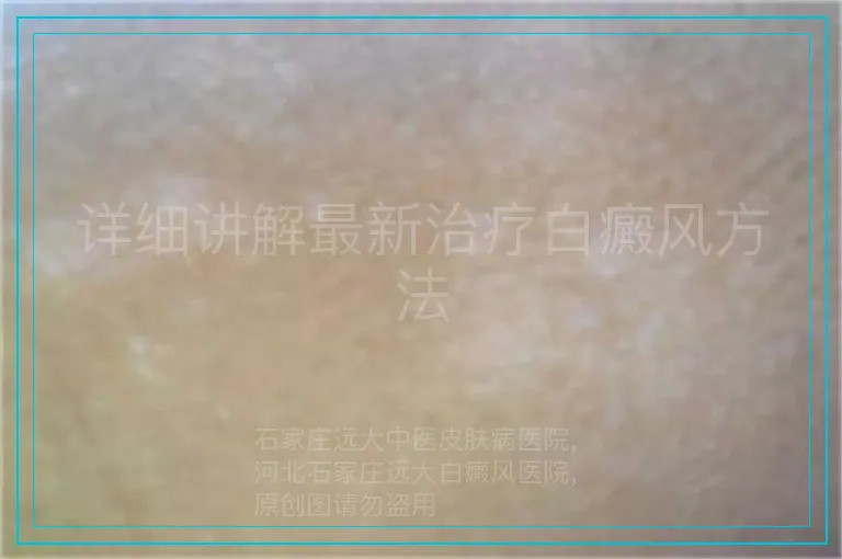 详细讲解最新治疗白癜风方法