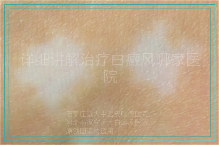 详细讲解治疗白癜风哪家医院