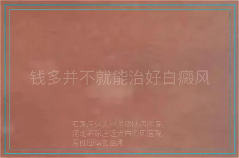 钱多并不就能治好白癜风