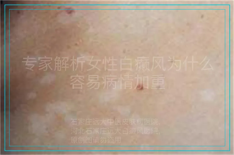 专家解析女性白癫风为什么容易病情加重