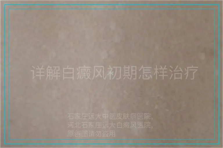  详解白癜风初期怎样治疗