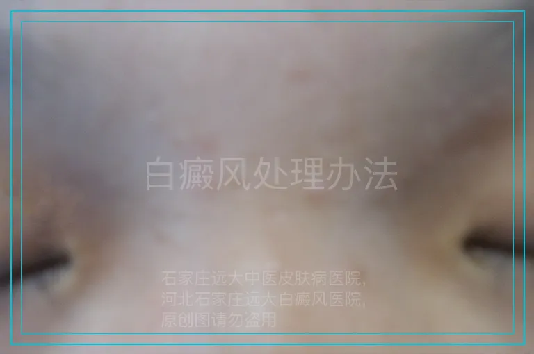 白癜风处理办法