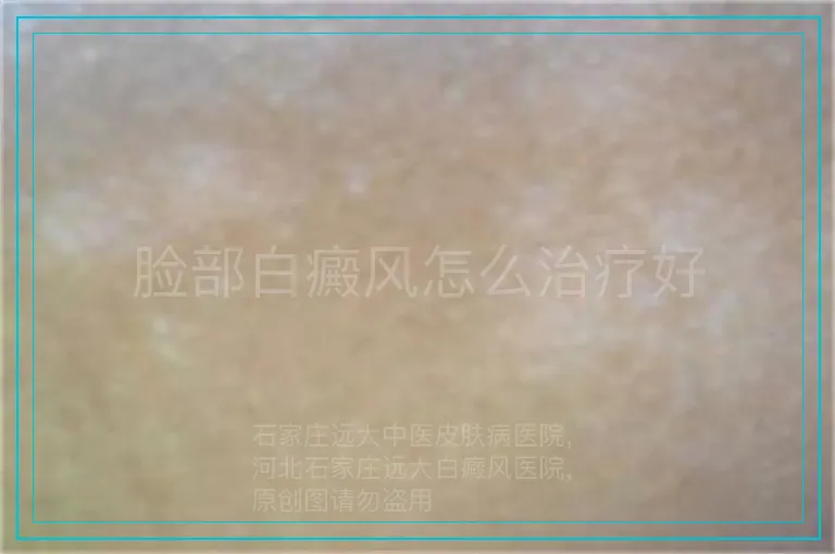 脸部白癜风怎么治疗好