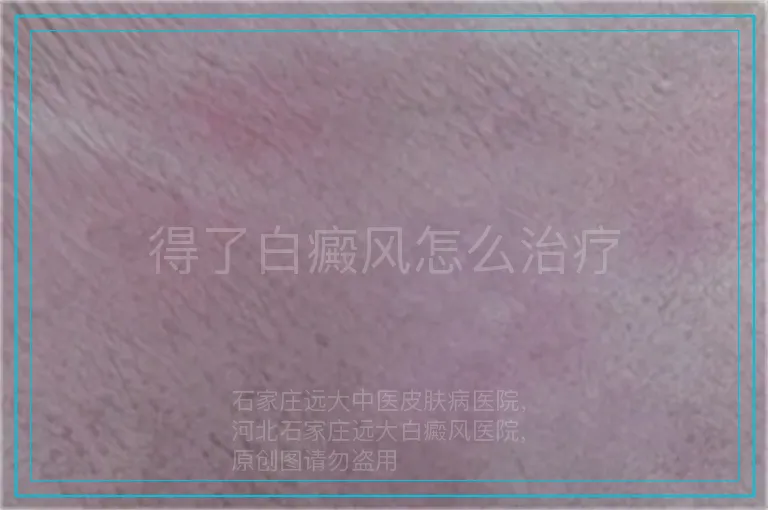 得了白癜风怎么治疗