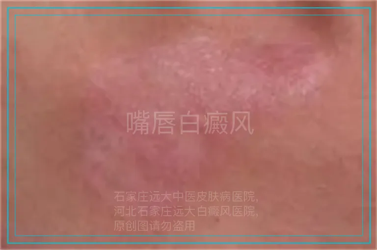 嘴唇白癜风