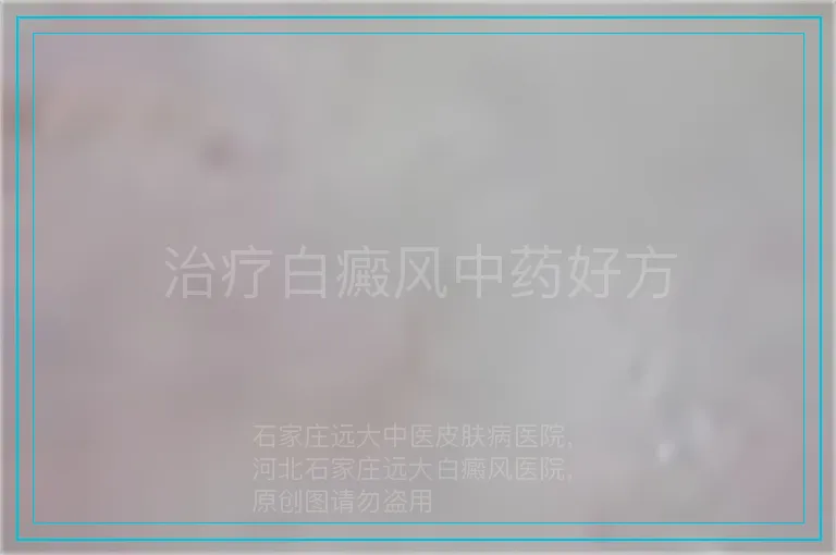 治疗白癜风中药好方