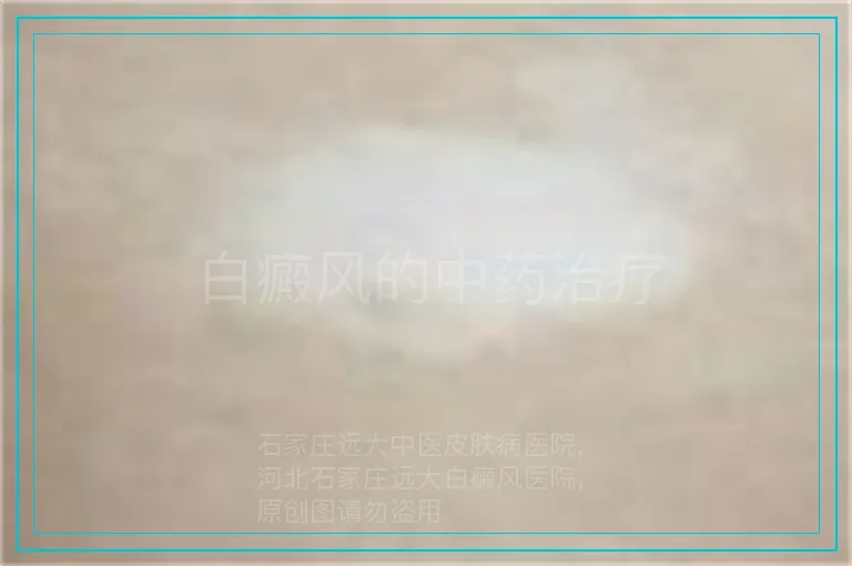 白癜风的中药治疗