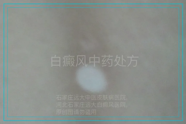 白癜风中药处方