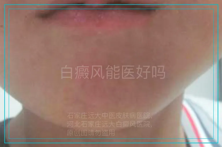 白癜风能医好吗