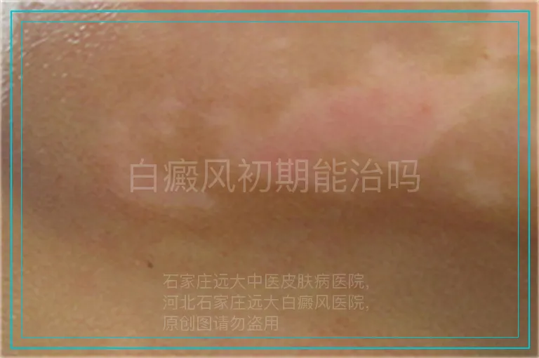 白癜风初期能治吗
