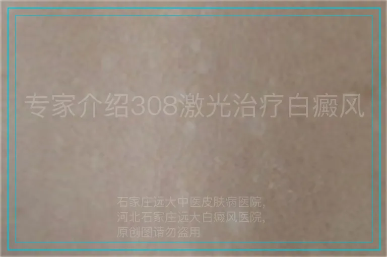 专家介绍308激光治疗白癜风
