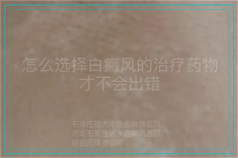 怎么选择白癜风的治疗药物才不会出错