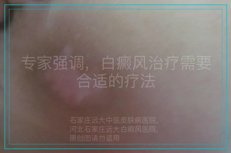 专家强调，白癜风治疗需要合适的疗法