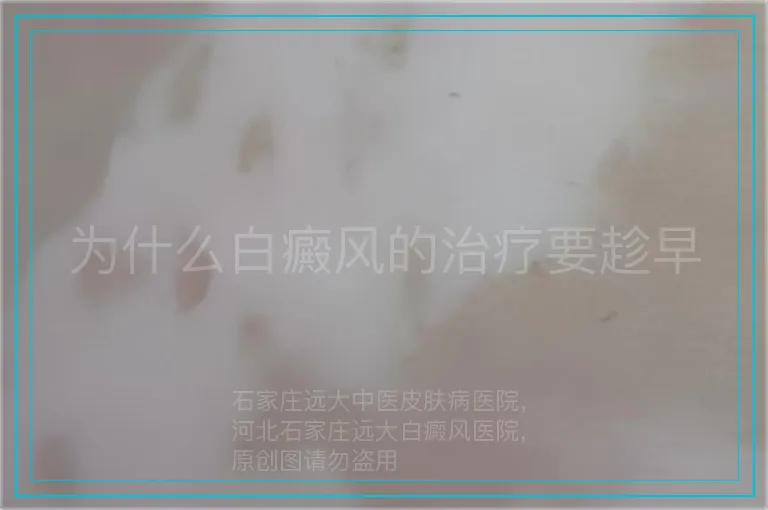为什么白癜风的治疗要趁早
