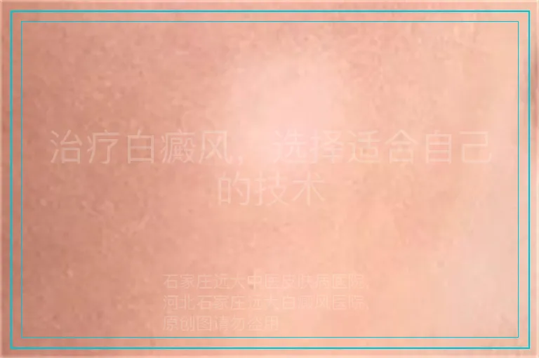 治疗白癜风,选择适合自己的技术