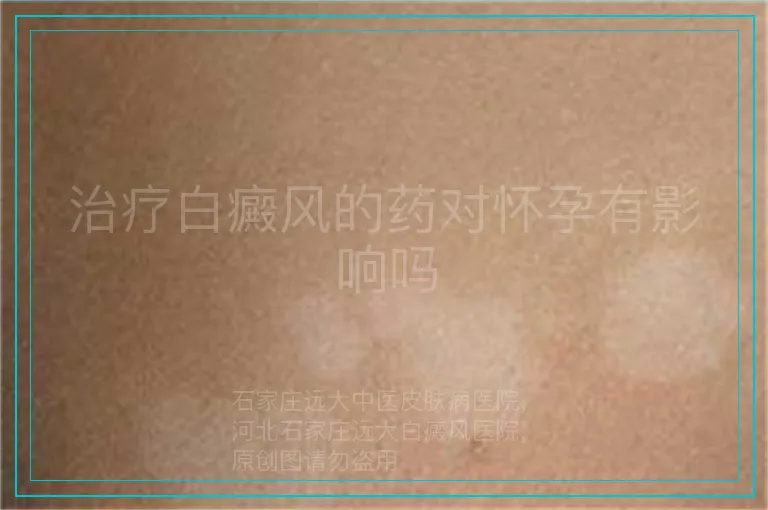 治疗白癜风的药对怀孕有影响吗