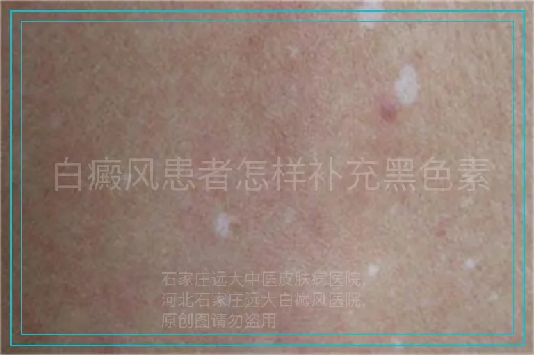 白癜风患者怎样补充黑色素