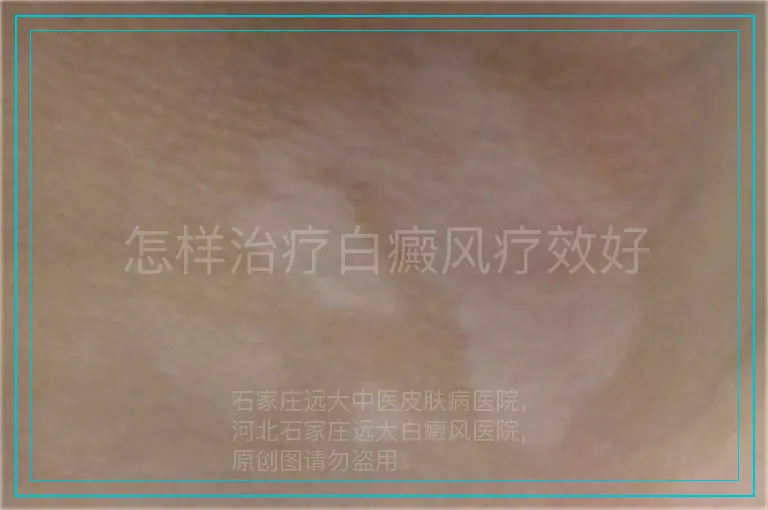 怎样治疗白癜风疗效好