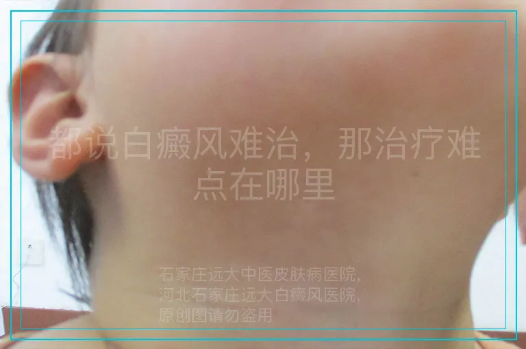 都说白癜风难治，那治疗难点在哪里