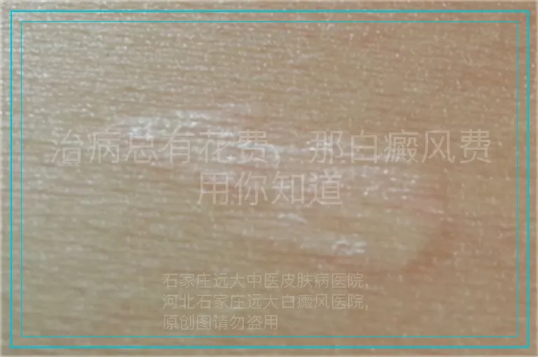 治病总有花费,那白癜风费用你知道