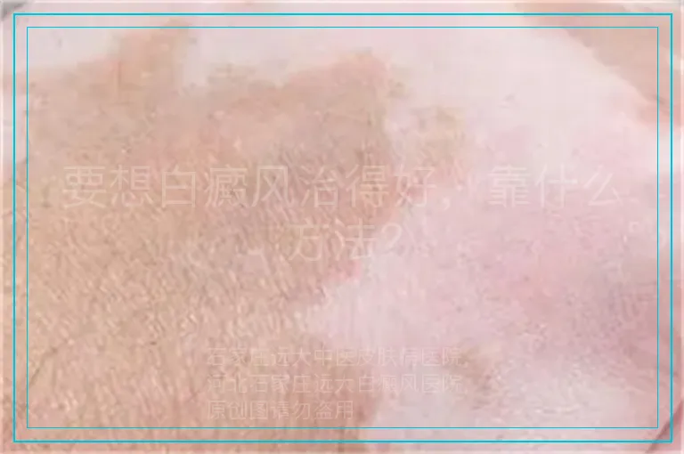 要想白癜风治得好,靠什么方法?
