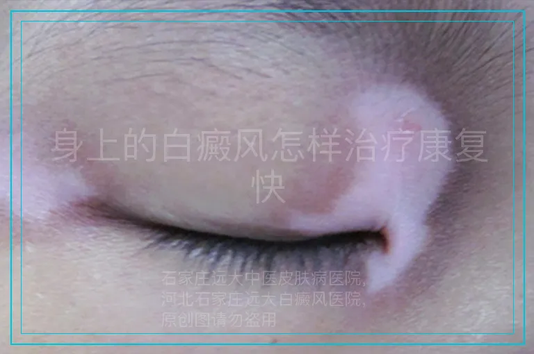身上的白癜风怎样治疗康复快