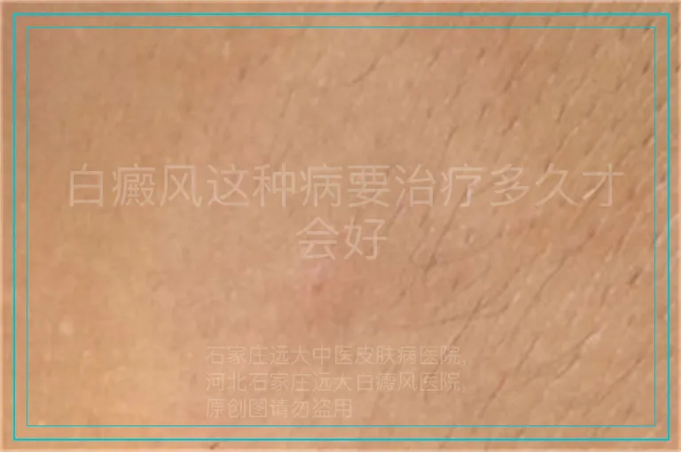 白癜风这种病要治疗多久才会好