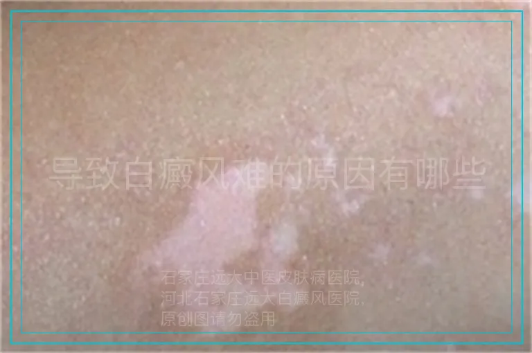 导致白癜风难的原因有哪些