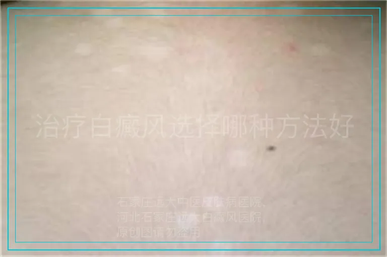 治疗白癜风选择哪种方法好