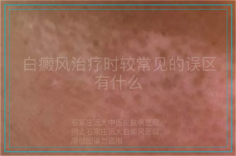 白癜风治疗时较常见的误区有什么