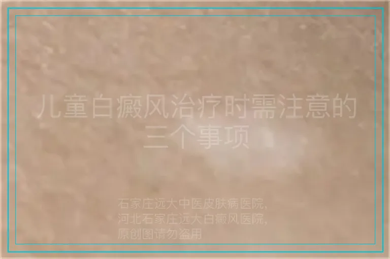 儿童白癜风治疗时需注意的三个事项