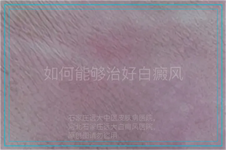 如何能够治好白癜风
