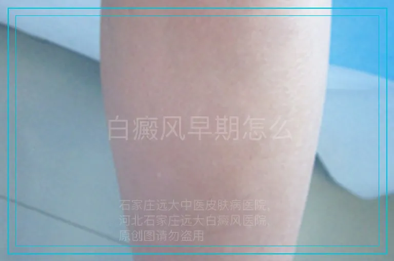 白癜风早期怎么