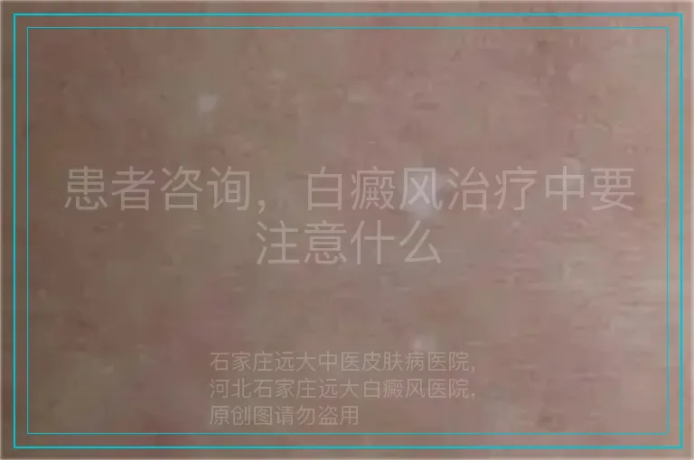 患者咨询,白癜风治疗中要注意什么