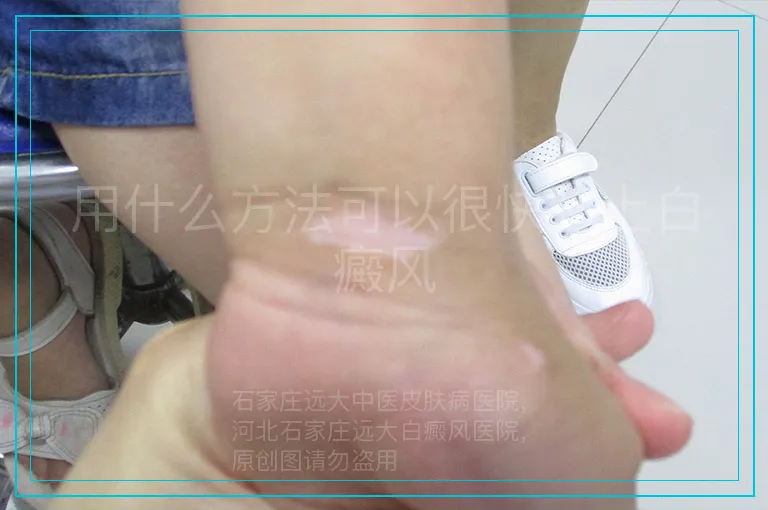用什么方法可以很快脸上白癜风