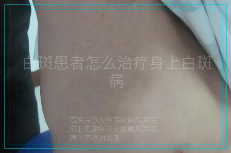 白斑患者怎么治疗身上白斑病