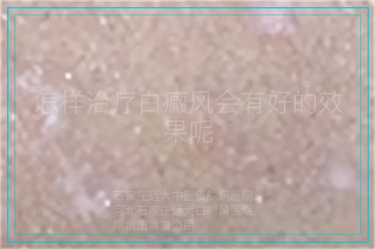 怎样治疗白癜风会有好的效果呢