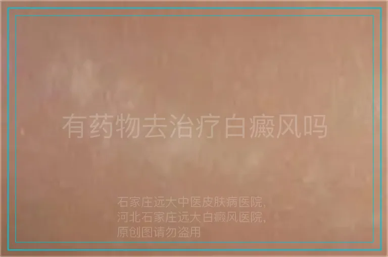 有药物去治疗白癜风吗