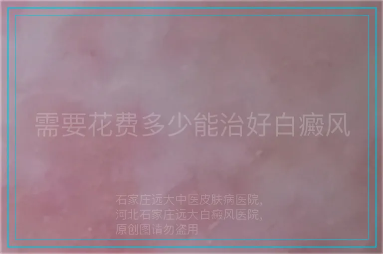 需要花费多少能治好白癜风