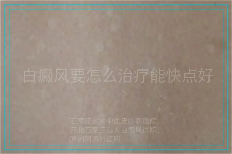 白癜风要怎么治疗能快点好