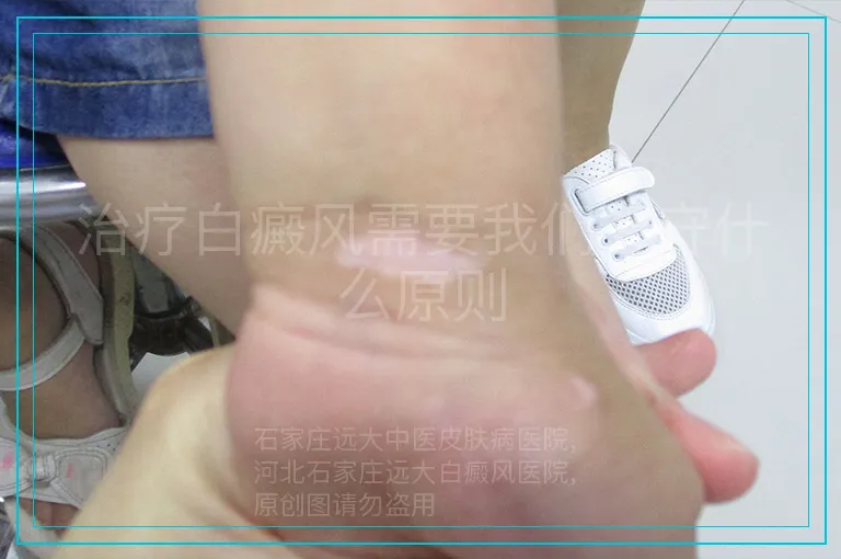 治疗白癜风需要我们遵守什么原则