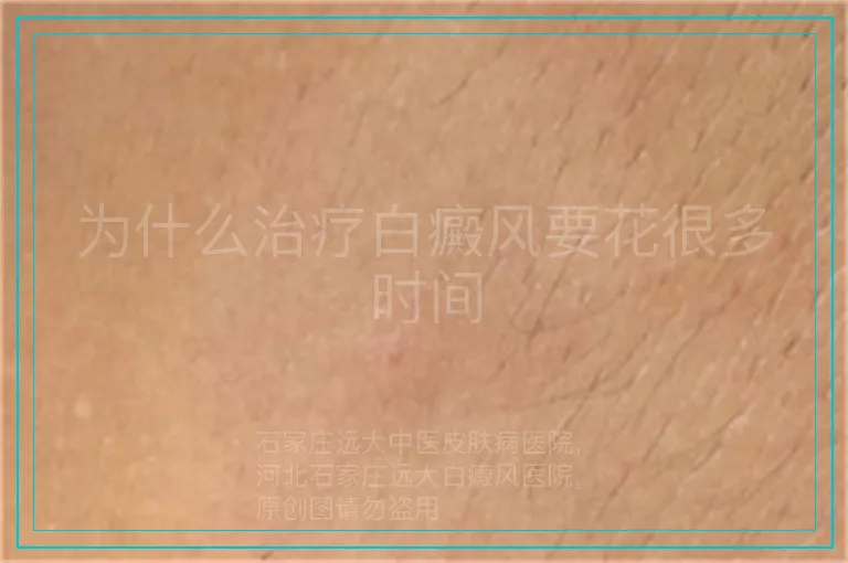 为什么治疗白癜风要花很多时间