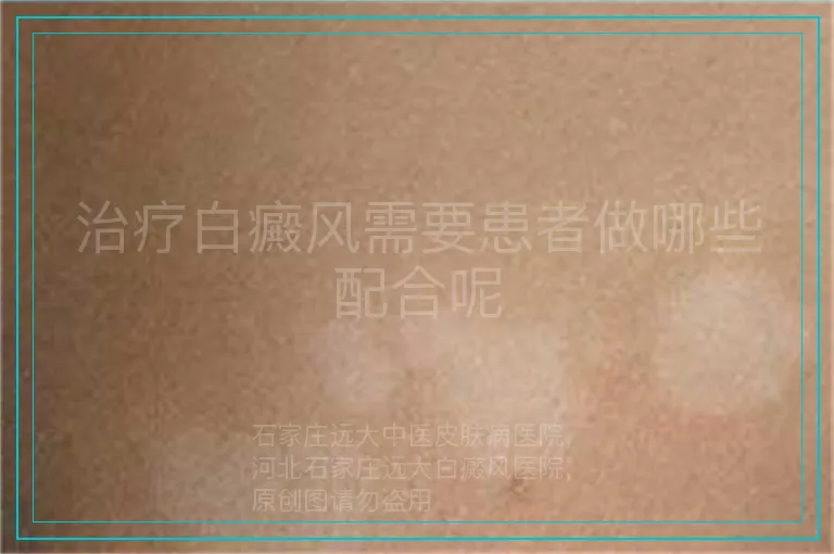 治疗白癜风需要患者做哪些配合呢