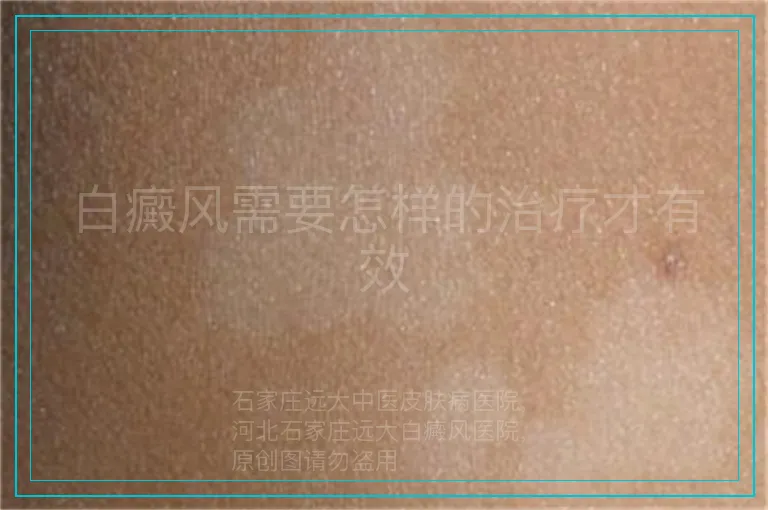 白癜风需要怎样的治疗才有效