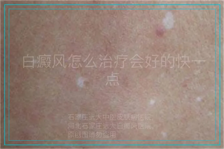 白癜风怎么治疗会好的快一点