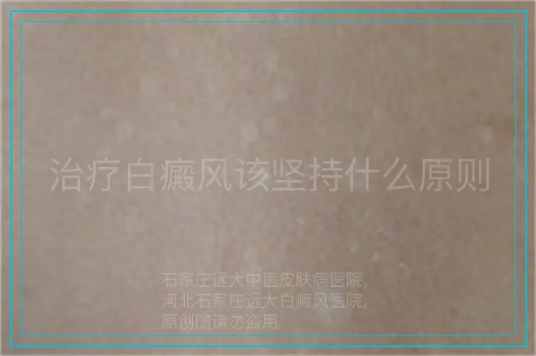 治疗白癜风该坚持什么原则