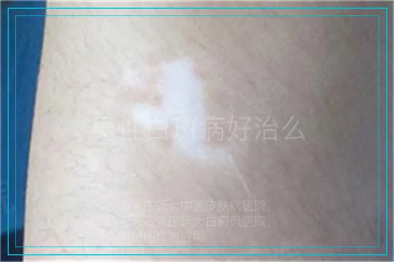 男性白斑病好治么